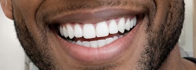 low cost veneers close up from mexico smile dental clinic in Merida Mexico